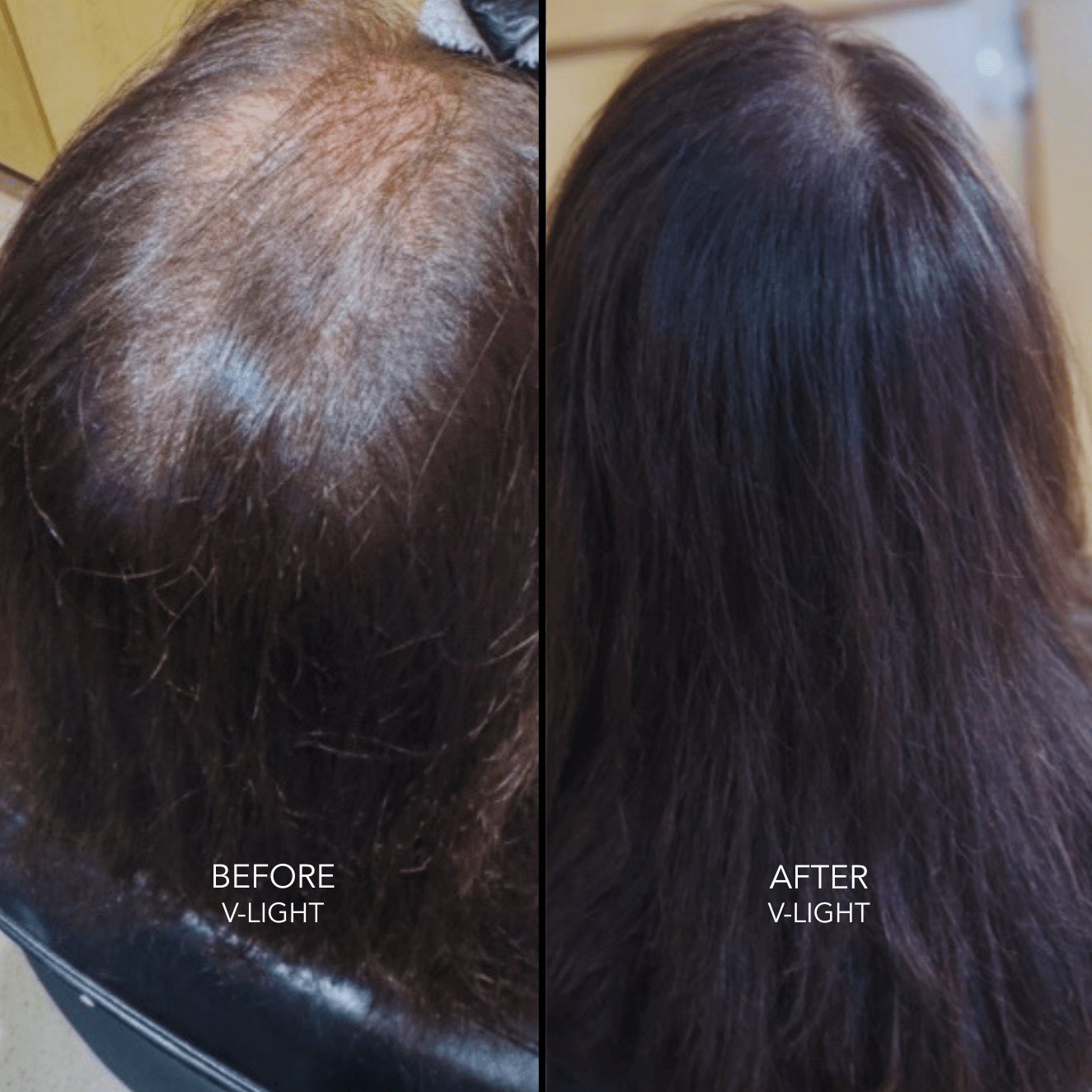 Fusion & V-Light Certification Class Education Class Tony Odisho Wholesale 